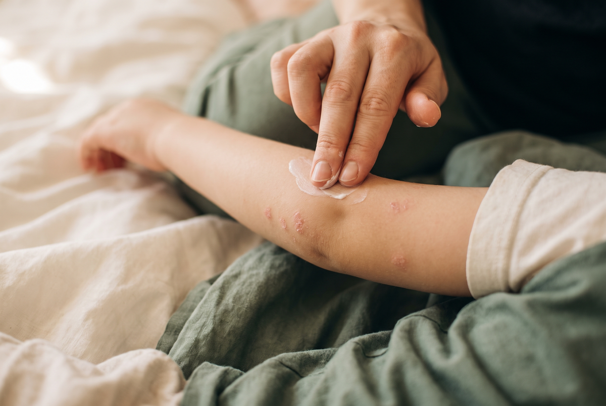 Eczema